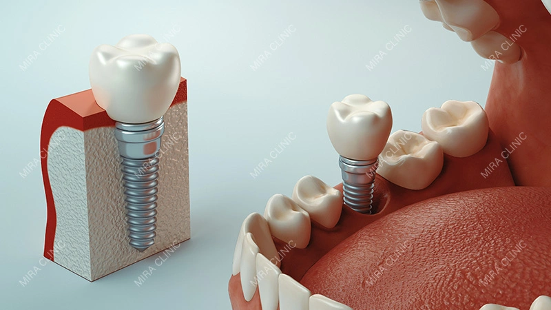 Dental Implant
